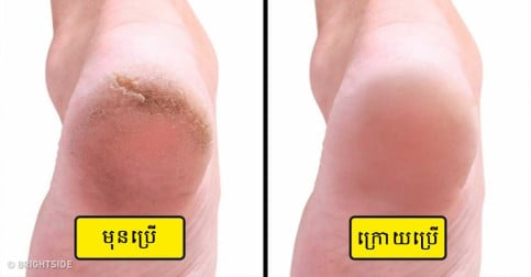 វិធីទាំង៧ មានប្រសិទ្ធភាពខ្ពស់ ដើម្បីកម្ចាត់ប្រេះកែងជើង ឱ្យបាត់ជារៀងរហូត!
