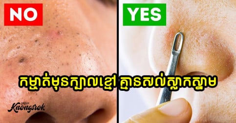 ៥ វិធីងាយៗ ដើម្បីកម្ចាត់មុនក្បាលខ្មៅ យ៉ាងមានប្រសិទ្ធភាព និងមិនឲ្យមានសល់ស្លាកស្នាម-v2