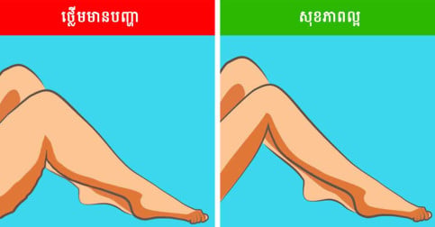 សញ្ញាទាំង ៦ ដែលលេចឡើងលើជើង អាចបង្ហាញថា អ្នកកំពុងមានបញ្ហាសុខភាពធ្ងន់ធ្ងរ