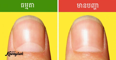 ១៣ សញ្ញានៃបញ្ហាសុខភាពនៅលើក្រចកដៃ ដែលអាចដាស់តឿនអ្នកឱ្យដឹងពីបញ្ហាសុខភាព