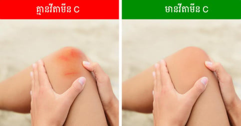 បញ្ហាសុខភាពដំបូងទាំង ១០ របស់រាងកាយ ដែលបណ្តាលមកពីការខ្វះវីតាមីន C