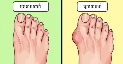១០ ហេតុផលនេះ អ្នកមិនគួរពាក់ស្បែកជើងផ្ទាត់ឡើយ ដើម្បីសុខភាពជើងរបស់អ្នក