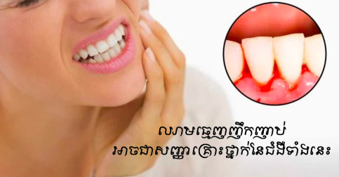 ការព្រមានអំពីគ្រោះថ្នាក់ធ្ងន់ធ្ងរ បើធ្មេញរបស់អ្នកបញ្ចេញសញ្ញាហូរឈាមជាញឹកញាប់