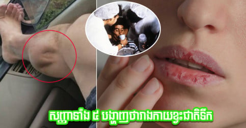 កុំមើលស្រាល! សញ្ញាព្រមាន ៥ នេះ បង្ហាញចំៗថារាងកាយអ្នកកំពុងខ្វះជាតិទឹក
