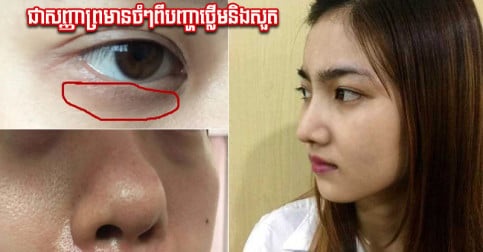 ផ្នែកទាំង ៣ លើរាងកាយឡើងពណ៌ខ្មៅ ជាសញ្ញាព្រមានចំៗពីបញ្ហាថ្លើមនិងសួត
