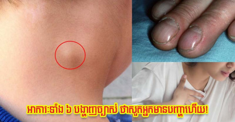 ចង់ដឹងសួតអ្នកនៅល្អឬអត់ មកសង្កេត ៦ ចំណុចនេះ បើមានមួយជារឿងគួរឲ្យបារម្ភហើយ