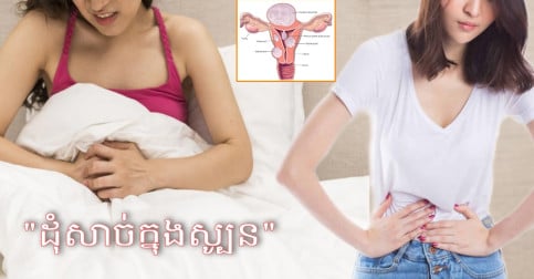 កត្តាដែលគួរយល់ដឹងពីជំងឺ “ដុំសាច់ក្នុងស្បូន” ដើមហេតុធ្វើឲ្យពិបាកមានកូន