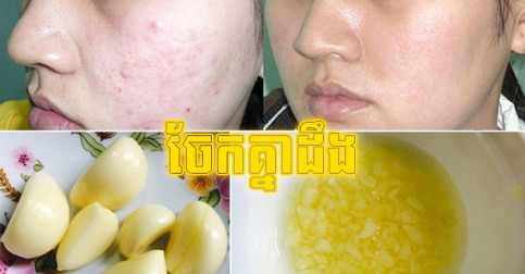 ចែក​គ្នា​ដឹង! រូបមន្ត​ប្រើ​ខ្ទឹម​ស អាច​ព្យាបាល​មុខ​មុន យ៉ាង​មាន​សុវត្ថិភាព​និង​ប្រសិទ្ធភាព