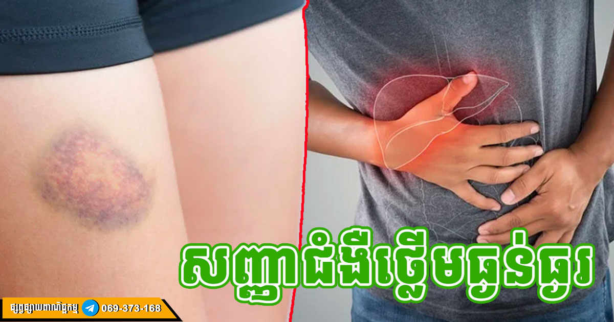 សញ្ញាទាំង ៥ ប្រកាសអាសន្នថា ថ្លើមអ្នកធ្លាក់ដល់កម្រិតធ្ងន់ធ្ងរហើយ