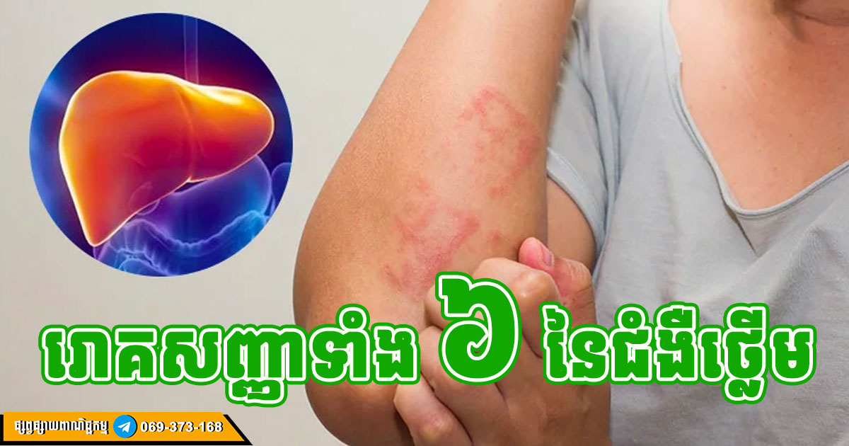 សញ្ញាព្រមានទាំង ៦ ដាស់តឿន ប្រញាប់រកពេទ្យបន្ទាន់ ពាក់ព័ន្ធនឹងជំងឺថ្លើម