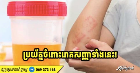 លេចឡើងសញ្ញា ឬស្លាកស្នាមទាំងនេះលើរាងកាយ មានន័យថាអ្នកកំពុងតែប្រឈមនឹងគ្រោះថ្នាក់ហើយ-v2