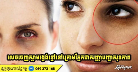 កុំប្រហែស! លេចចេញស្នាមរង្វង់ខ្មៅនៅក្រោមភ្នែក គឺជាសញ្ញាបញ្ហាសុខភាពទាំង ៥ យ៉ាងនេះ-2