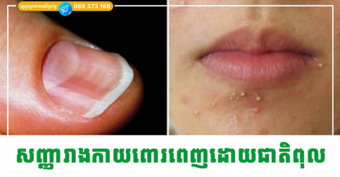 សញ្ញាទាំង៥លើរាងកាយ បញ្ជាក់ថា សរីរាង្គខាងក្នុងរបស់អ្នកផ្ទុកដោយជាតីពុលកខ្វក់ជាច្រើន គួរឱ្យព្រួយបារម្ភ