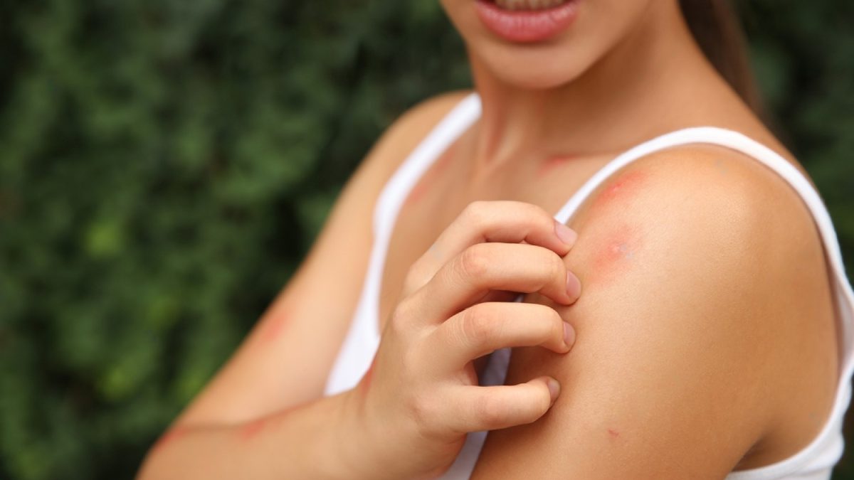 Stock Photo Woman Scratching Shoulder With Insect Bite Outdoors Closeup 1935530953 Transformed 1200x675