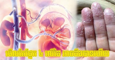 ចង់ដឹងថាបុរសនោះមានតម្រងនោម (ក្រលៀន) ល្អឬអត់? សម្លឹងតែ ៤ ផ្នែកនៅលើដៃ អាចដឹងបានច្រើន! ✋🩺