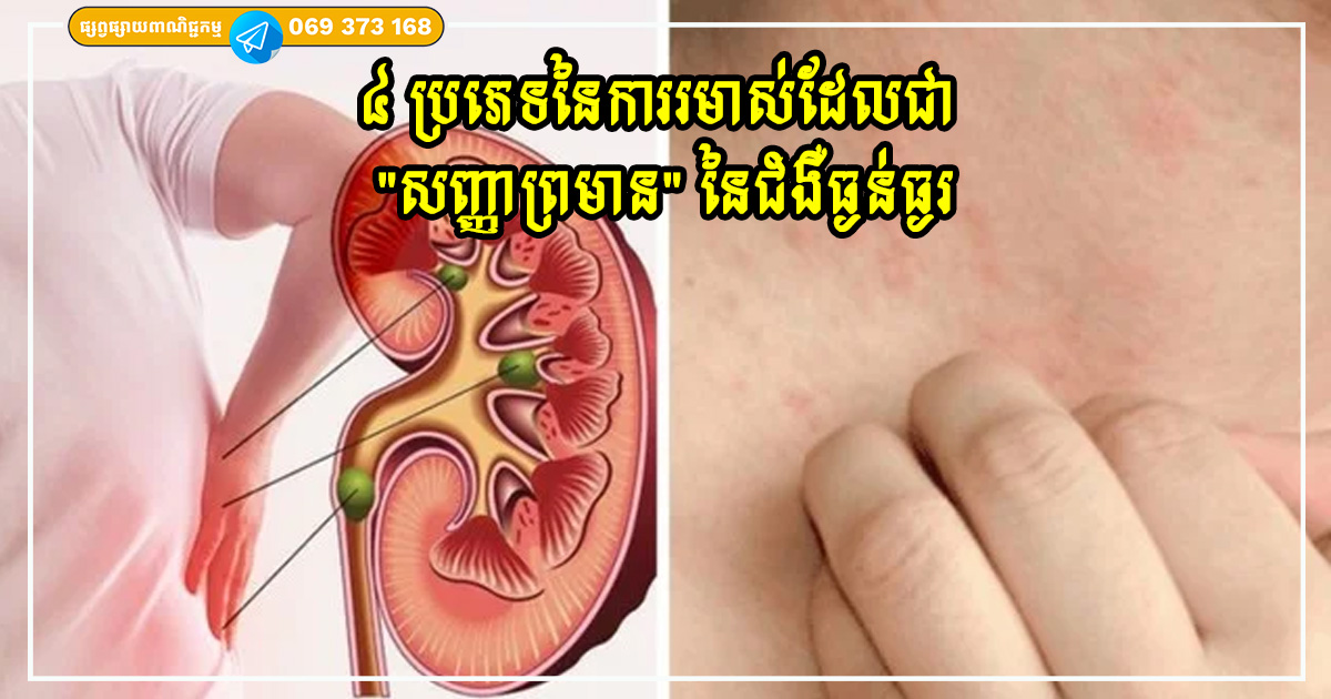 ៤ ប្រភេទនៃការរមាស់ដែលជា “សញ្ញាព្រមាន” នៃជំងឺធ្ងន់ធ្ងរ ៤ ប្រភេទនៃការរមាស់ដែលជា “សញ្ញាព្រមាន” នៃជំងឺធ្ងន់ធ្ងរ
