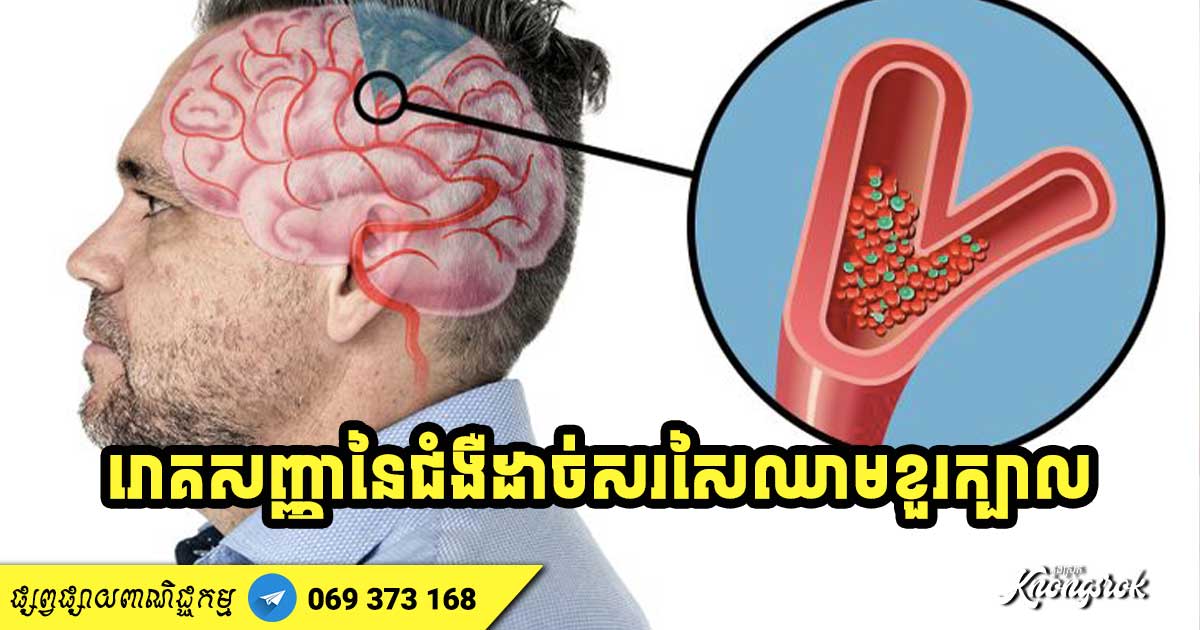 លេចឡើងរោគសញ្ញាទាំង ៦ នេះ មានន័យថាអ្នកមានជំងឺដាច់សរសៃឈាមខួរក្បាល និងត្រូវប្រយ័ត្នឱ្យបានខ្ពស់! លេចឡើងរោគសញ្ញាទាំង ៦ នេះ មានន័យថាអ្នកមានជំងឺដាច់សរសៃឈាមខួរក្បាល និងត្រូវប្រយ័ត្នឱ្យបានខ្ពស់!